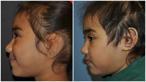 Before And After CAM Combined Atresia Repair And Medpor The