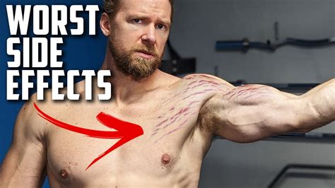 Worst Bodybuilding Side Effects No One Wants To Talk About Youtube