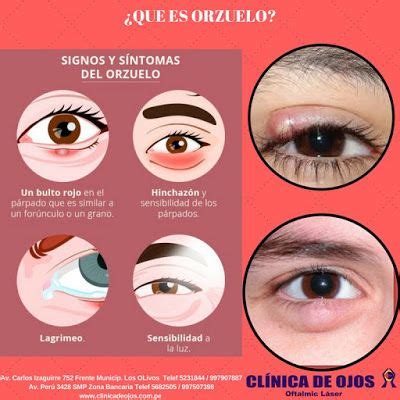 Clínica de Ojos Oftalmic Láser QUE ES ORZUELO Eye health Human