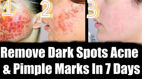 How To Remove Dark Spots Acne Scars And Pimple Marks In 7 Days Superprincessjo Youtube