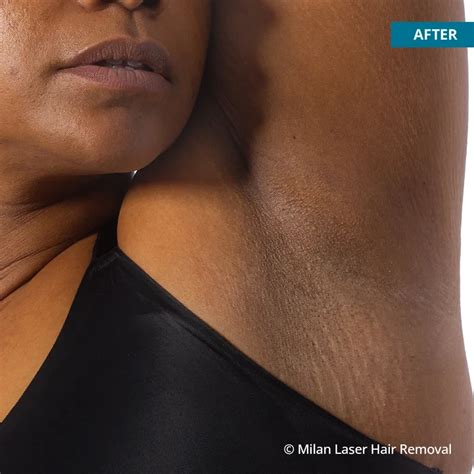 Underarm Before After Photos Of Laser Hair Removal Milan Laser In