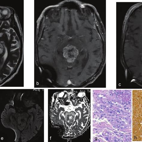 A A Hetrogeneously T2W Hyperintense Lesion In Pineal Region With