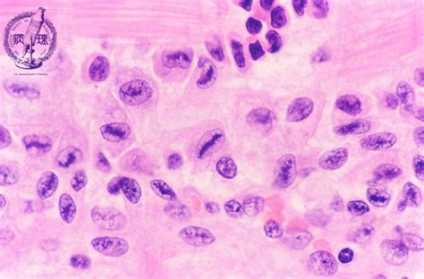 3.Cardiovascular system (5) Valvular disease (acute rheumatic fever)|Pathology Core Pictures