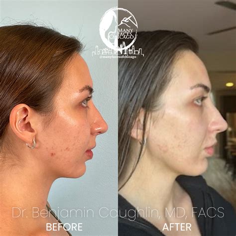 Combination Of Buccal Fat Removal Jawline Sculpting Chin Implant