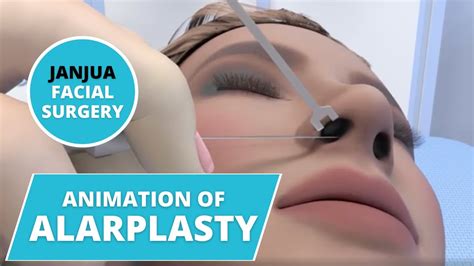 Animation Of Alarplasty Dr Tanveer Janjua New Jersey Youtube