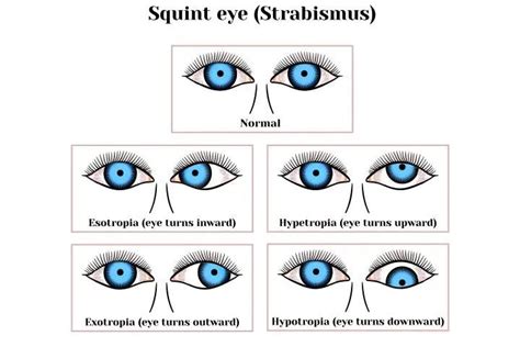 Strabismus In Infants Symptoms Causes Diagnosis And Risks