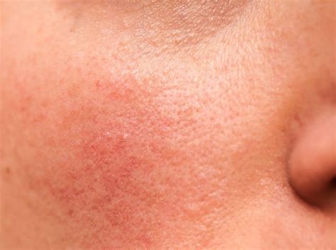 Rosacea Causes And Treatments Everything You Need To Know