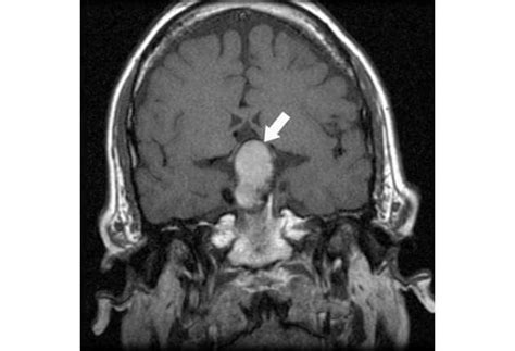 Pituitary Tumor (adenoma) | Wills Eye Hospital