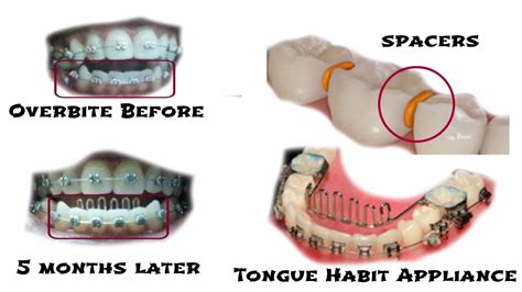 Braces Update 5 Months Overbite Rubberbands Tongue Habit Appliance Spacers Adjustment