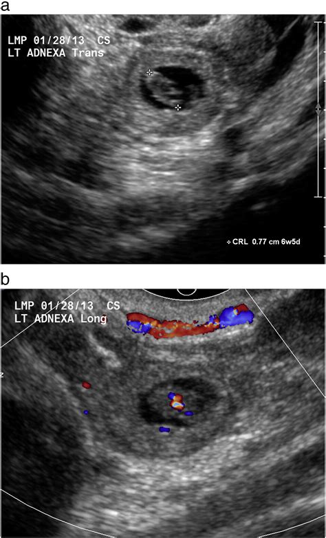 Pearls And Pitfalls In First Trimester Obstetric Sonography Clinical Imaging