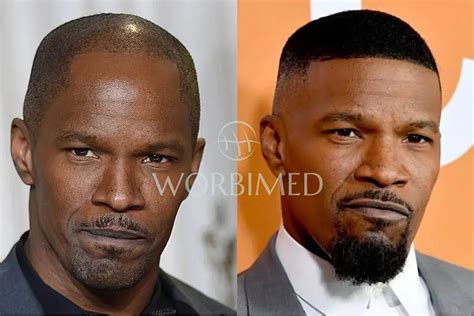 Jamie Foxx Hair Transplant L Before And After