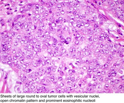 Pathology Outlines Lymphoepithelioma Like