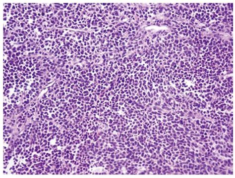 Adenocarcinoma Histology