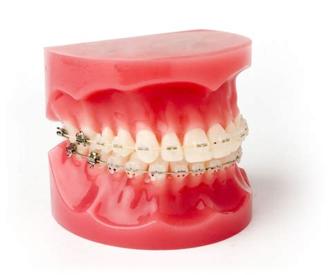 Parts Of Braces Innovative Orthodontic Centers