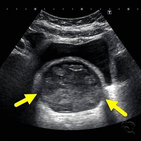 Transverse Ultrasound Image 1 Of The Pelvis In An Adolescent Girl