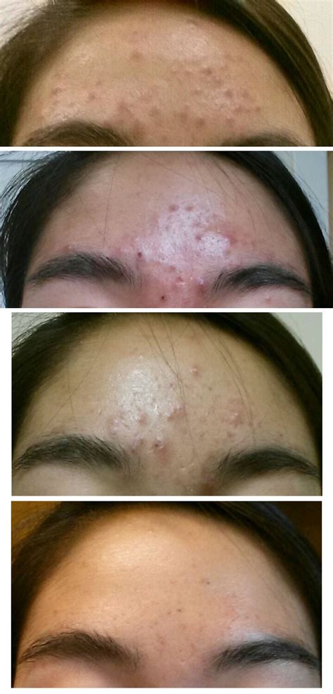 [B&A] Epiduo at night and Clindamycin gel in the morning - April 25 to ...