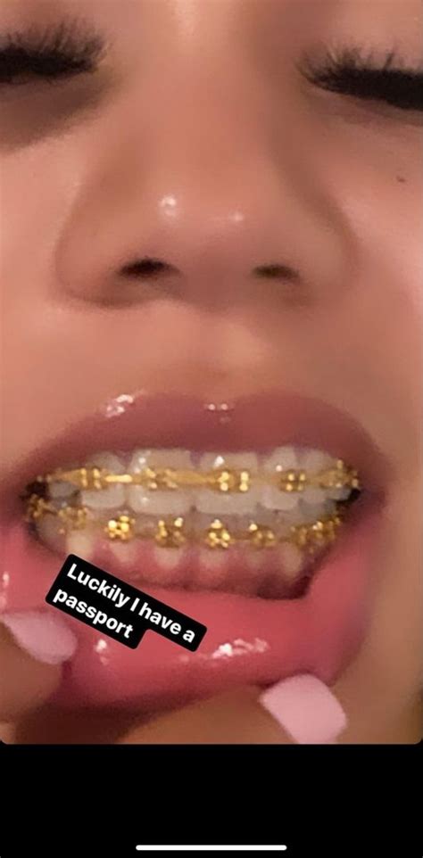 Braces Teeth Colors Cute Braces Colors Teeth Braces Pink Braces