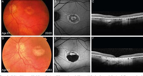 Figure From Macular Dystrophy And Cone Rod Dystrophy Caused By