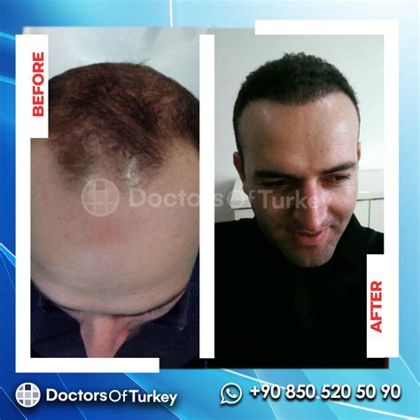 Hair Transplant Hair Transplant Turkey Doctorsofturkey Com