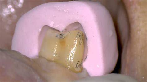 Tooth Preparation Of Right Premolar With Microscope Youtube