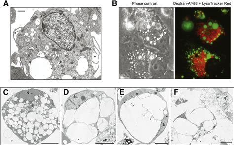 Examples Of U251 Human Gbm Cells Undergoing Methuosis Triggered By