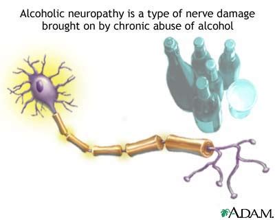 Alcoholic neuropathy: Symptoms & Signs, Diagnosis & Tests – Health32