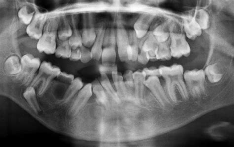 Odontogenic Keratocyst (OKC) – Exodontia