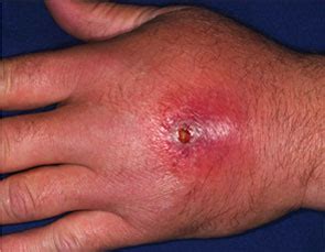 What Is The Best Empiric Therapy For Community Acquired Cellulitis