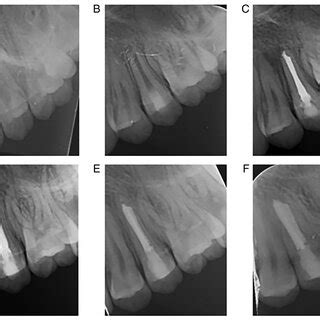 Follow Up Periapical Radiographs Of Tooth A Preoperative