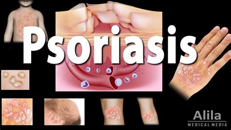 Psoriasis Types Symptoms Causes Pathology And Treatment Animation