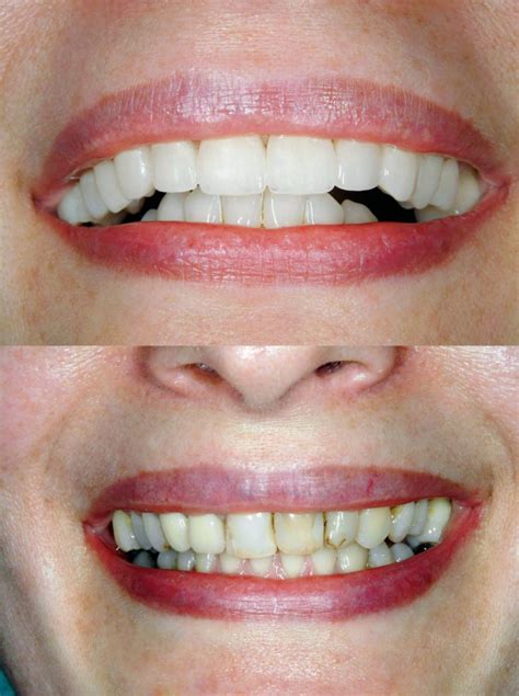 How Much Does A Full Set Of Veneers Cost In Turkey