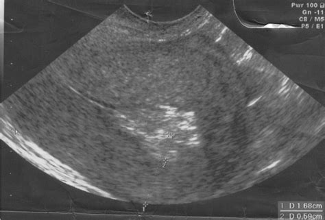 Combined Use Of Preoperative Transvaginal Ultrasonography And