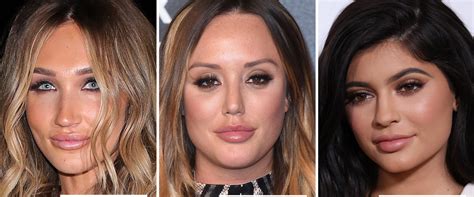 Celebrities Who Use Lip Fillers: A Comprehensive Guide