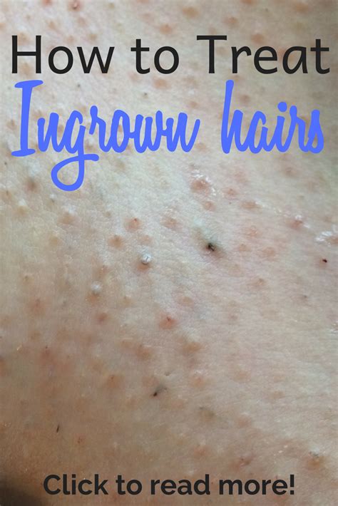 This Site Features Everything You Need To Know About Razor Burn Ingrown Hairs Bikini Bumps