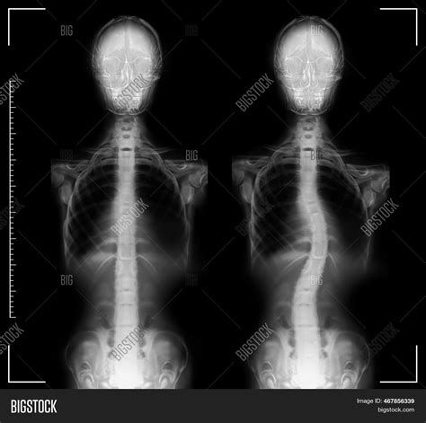 X Rays Human Normal Image And Photo Free Trial Bigstock