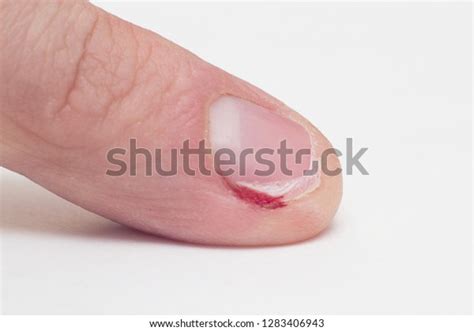 Finger Gnawed Nail Cuticle Blood Macro Stock Photo 1283406943