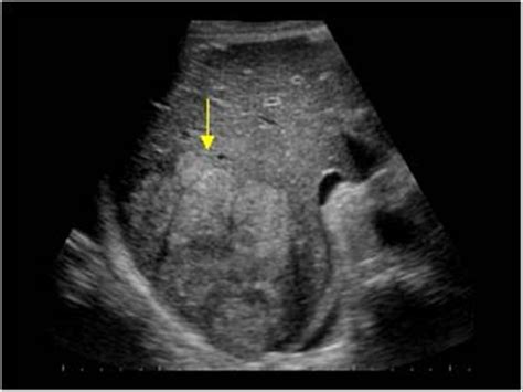 Abdomen and retroperitoneum | 1.1 Liver : Case 1.1.7 Hepatocellular ...