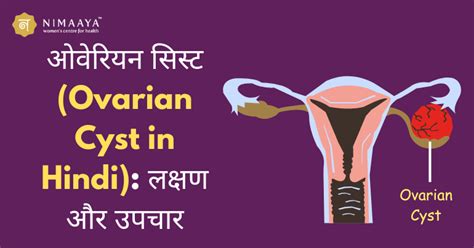 ओवेरियन सिस्ट Ovarian Cyst In Hindi लक्षण और उपचार