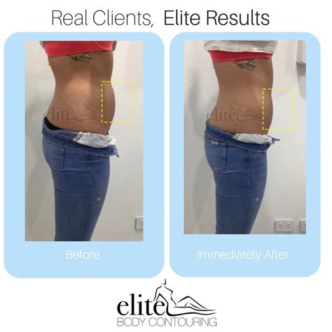 Client Results Elite Body Contouring Before And After Fat Freezing