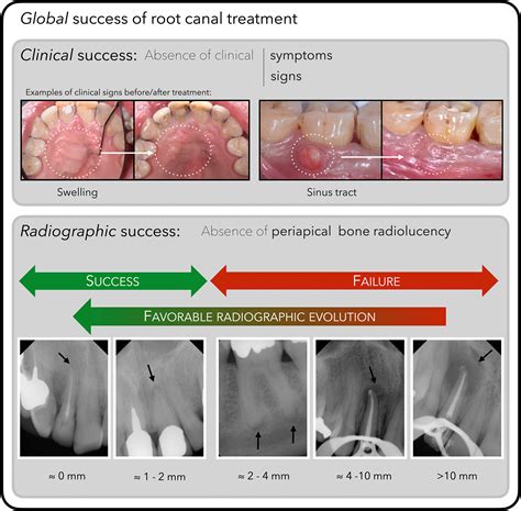 What Ultimately Matters In Root Canal Treatment Success And Tooth