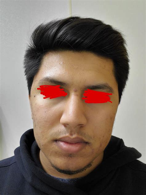 19 Year old male. Been dealing with acne since 5 years but it's finally