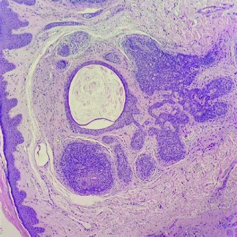 Photomicrograph Of Hande Stained Section Showing Well Circumscribed