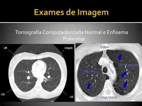 PPT DOENÇA PULMONAR OBSTRUTIVA CRÔNICA DPOC PowerPoint Presentation