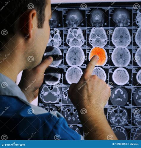 Ct Scan Of The Brain Mri Of The Brain Ischemic Stroke Stock Image