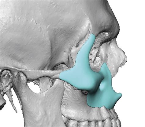 Plastic Surgery Case Study Extended Custom Midface Implant For A