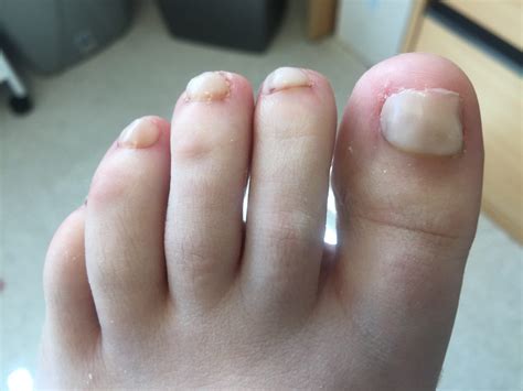 Effective Nail Reconstruction Professional Podiatry Chiropody