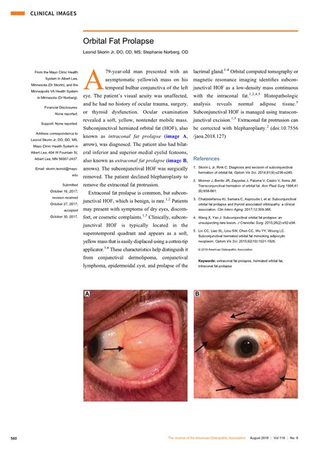 Pdf Orbital Fat Prolapse