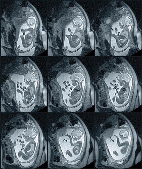 9 Month Foetus Mri Scans Photograph By Du Cane Medical Imaging Ltd