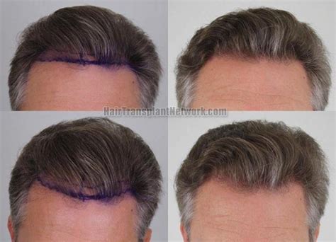 Dr H Rahal Hair Transplantation Surgery Before And After Result