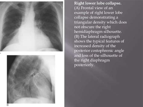 Collapse Radiology